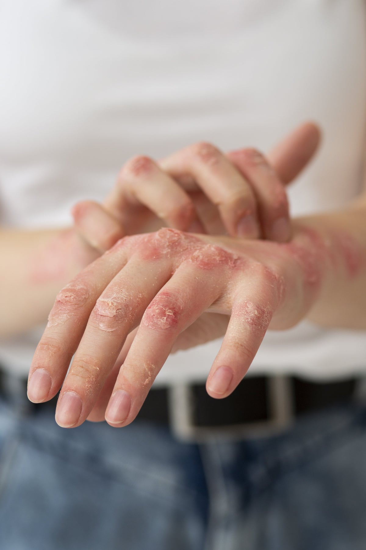 Peau sèche, sensible, tendance eczéma, que faire?
